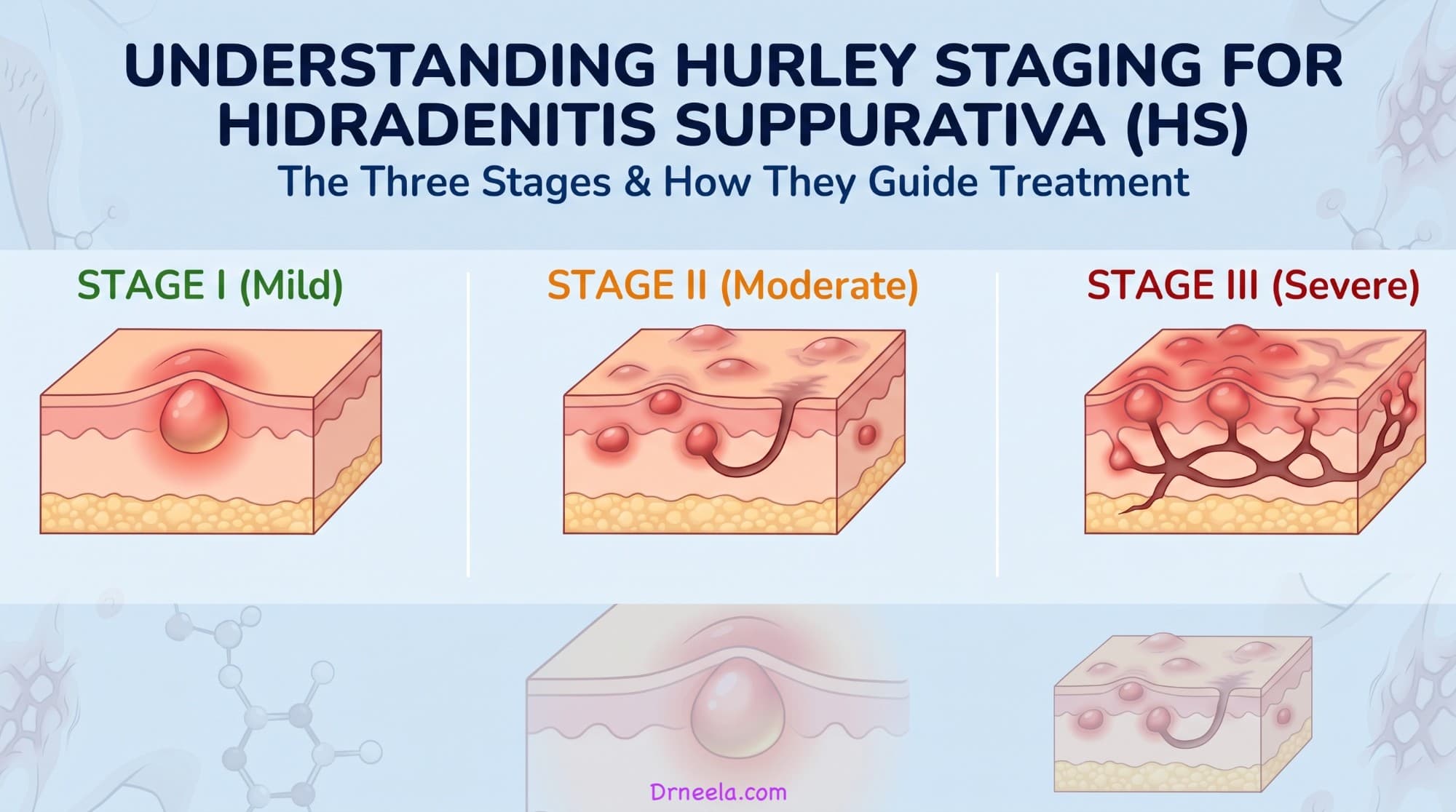 Infographic showing skin cross-sections for the three Hurley stages of HS: Stage I (mild) with a single abscess, Stage II (moderate) with several abscesses and a tunnel, and Stage III (severe) with interconnected tunnels and scarring